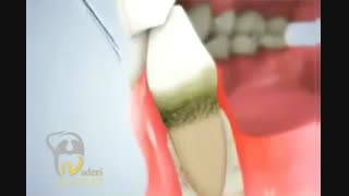 فیلم باور نکردنی از جرم گیری دندان و درمان التهاب لثه