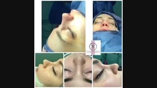 جراحی بینی ترمیمی با استفاده از غضروف گوش