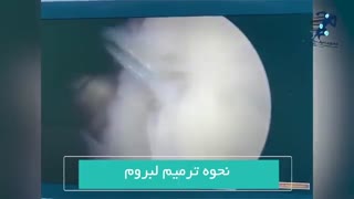 فیلم جراحی آرتروسکوپی شانه و ترمیم لابروم