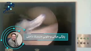 فیلم عمل ترمیم منیسک زانو
