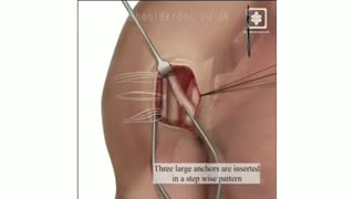فیلم جراحی پارگی قدیمی عضله سینه ای بزرگ (پکتورالیس ماژور)