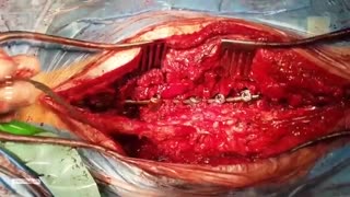 فیلم عمل جراحی مجدد فیوژن کمری