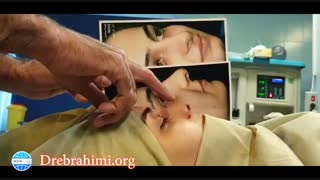 فیلم جراحی بینی گوشتی