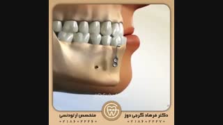 مینی پلیت ها | دکتر فرهاد گرجی دوز
