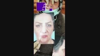 فیلم جراحی بینی و باز کردن اسپلینت