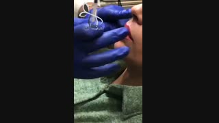 معجزه اصلاح لبخند لثه نما با بوتاکس