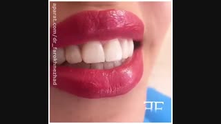 لمینت دندان