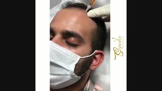 مزوتراپی مو برای قهرمان پرورش اندام