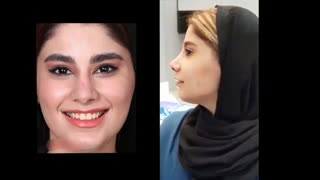 فیلم واقعی عمل بینی استخوانی