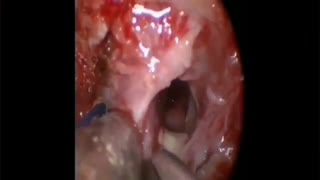 فیلم جراحی آندوسکوپی آدنوم هیپوفیز