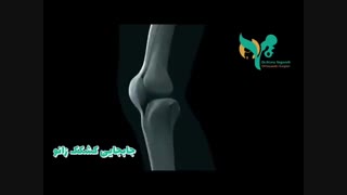 فیلمی کوتاه از جا بجایی کشکک زانو