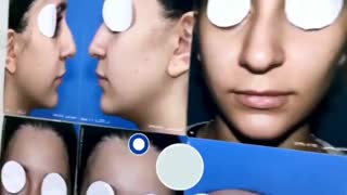 لیفت لب و جراحی بینی