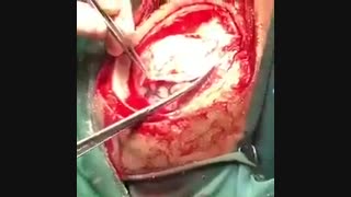 بیرون کشیدن لخته خون از مغز- ویدئو شامل تصاویر نامناسب برای افراد زیر 18 سال