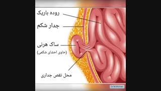 هرنی یا فتق جدار شکم چیست؟