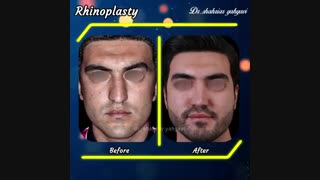 نمونه کار جراحی بینی