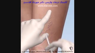 اسکلروتراپی یک راه درمان رگ های واریسی و عنکبوتی