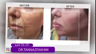 فیلم نمونه واقعی جوانسازی صورت با تزریق چربی