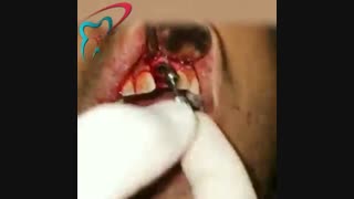 فیلم ایمپلنت دندان یک بالا