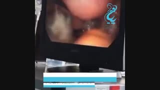فیلم واقعی لاپاراسکوپی کیست تخمدان