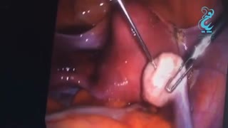 فیلم واقعی انجام prp تخمدان