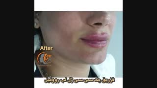 فیلم تزریق ژل لب