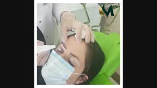فیلم واقعی بلفاروپلاستی (رفع افتادگی پلک)بدون جراحی