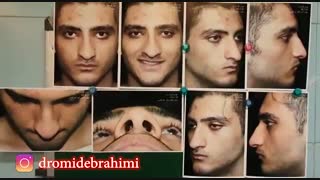 اصلاح افتادگی نوک بینی گوشتی توسط دکتر امید ابراهیمی بهترین جراح بینی گوشتی در تهران