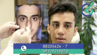 بررسی نتیجه عمل زیبایی بینی بعد از یک هفته!
