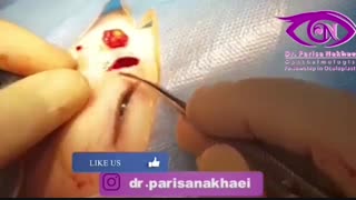 فیلم ولقعی جراحی تومور درموئید