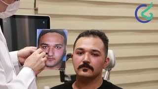 عمل بینی گوشتی مردانه توسط دکتر علی بصام