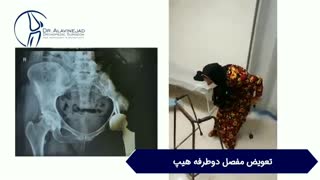 تعویض مفصل دوطرفه هیپ