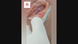 آموزش درمان آبسه شکم در محل انجام پیوند کلیه