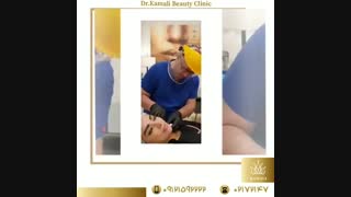 فیلم واقعی زیبا سازی چانه با تزریق ژل