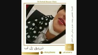 فیلم واقعی از تزریق ژل لب