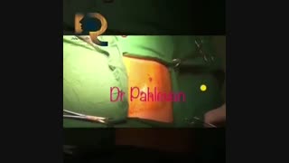 بستن ارتباط بینی-دهانی وبازسازی نقص فک فوقانی