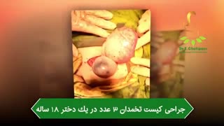 جراحى کیست تخمدان ٣عدد در یک دختر ١٨ساله