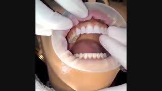 لمینت دندان