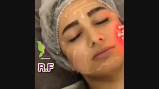 جوانسازی با لیزر آر اف معجزه زیبایی پر کردن دندان