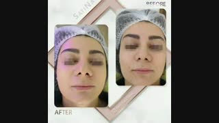 تاثیرات آر اف و میکرودرم روی پوست