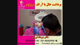 برداشت خال با آر اف سرجری
