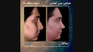فیلم جراحی بینی گوشتی