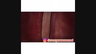 چطور یک حمله قلبی اتفاق می افتد ؟