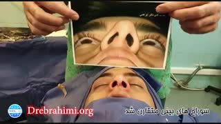 فیلم جراحی بینی کج