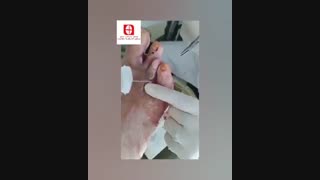 آموزش درمان زخم پای دیابتی در کلینیک زخم مرهم اندیشه سلامت مشهد