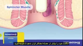نحوه استفاده از شیاف آنتی هموروئید یا ایپروئید