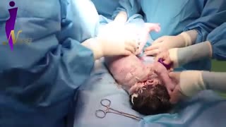 زایمان بریچ