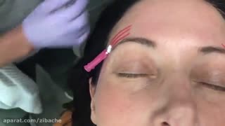 جاگذاری نخ PDO برای بالابردن ابرو