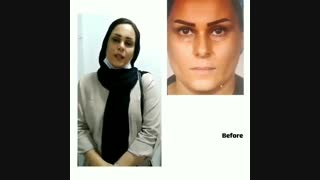 عمل بینی استخوانی قوزدار