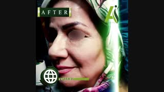 فیلم تزریق چربی به صورت پلاستیک لثه