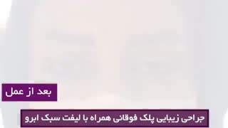 جراحی پلک بالا و لیفت ابرو